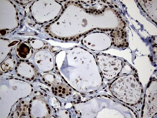 Immunohistochemical staining of paraffin-embedded Human thyroid tissue within the normal limits using anti-PSMA7 mouse monoclonal antibody