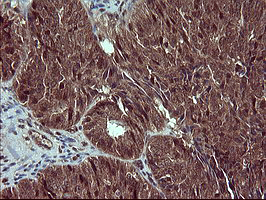 Immunohistochemical staining of paraffin-embedded Adenocarcinoma of Human ovary tissue using anti-CSH1 mouse monoclonal antibody