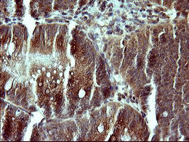 Immunohistochemical staining of paraffin-embedded Carcinoma of Human pancreas tissue using anti-CSH1 mouse monoclonal antibody