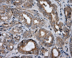 Immunohistochemical staining of paraffin-embedded Carcinoma of prostate tissue using anti-HDAC10 mouse monoclonal antibody