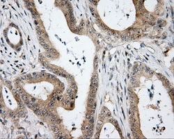 Immunohistochemical staining of paraffin-embedded Adenocarcinoma of colon tissue using anti-HDAC10 mouse monoclonal antibody
