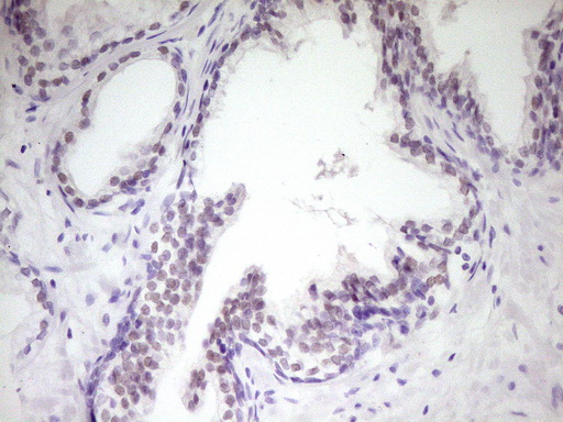 Immunohistochemical staining of paraffin-embedded Carcinoma of Human prostate tissue using anti-HIPK1 mouse monoclonal antibody