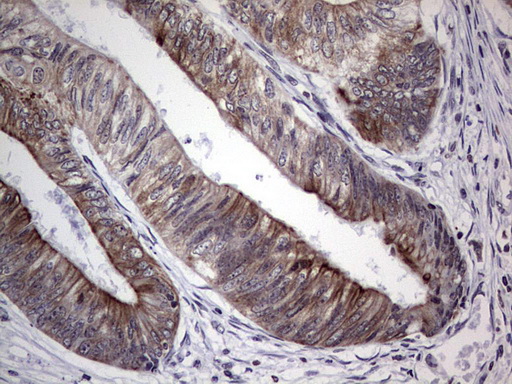 Immunohistochemical staining of paraffin-embedded Adenocarcinoma of Human colon tissue using anti-DBNL mouse monoclonal antibody