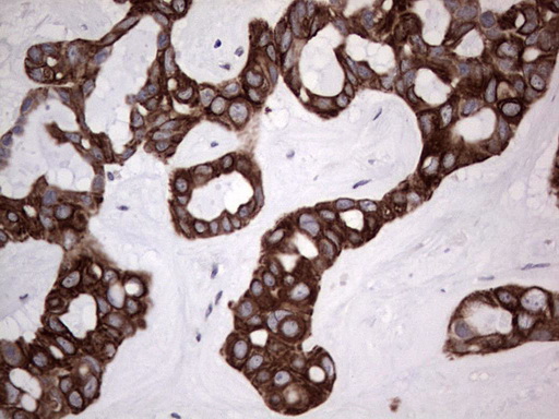 Immunohistochemical staining of paraffin-embedded Carcinoma of Human liver tissue using anti-DBNL mouse monoclonal antibody