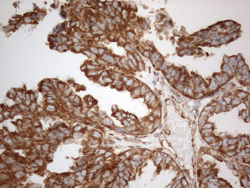 Immunohistochemical staining of paraffin-embedded Adenocarcinoma of Human ovary tissue using anti-VAPA mouse monoclonal antibody