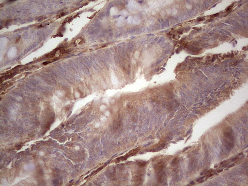 Immunohistochemical staining of paraffin-embedded Adenocarcinoma of Human colon tissue using anti-RSPO3 mouse monoclonal antibody