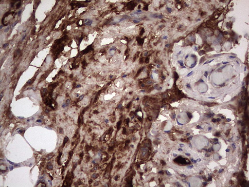 Immunohistochemical staining of paraffin-embedded Adenocarcinoma of Human ovary tissue using anti-RSPO3 mouse monoclonal antibody
