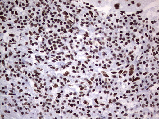 Immunohistochemical staining of paraffin-embedded Carcinoma of Human lung tissue using anti-PPP1R8 mouse monoclonal antibody