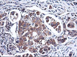 Immunohistochemical staining of paraffin-embedded Carcinoma of Human lung tissue using anti-HMOX2 mouse monoclonal antibody