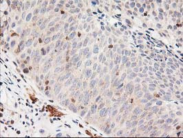 Immunohistochemical staining of paraffin-embedded Carcinoma of Human bladder tissue using anti-LSM1 mouse monoclonal antibody