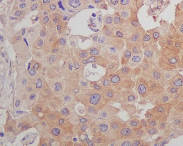 Immunohistochemical analysis of paraffin-embedded human breast carcinoma, using beta Tubulin Mouse Monoclonal Antibody