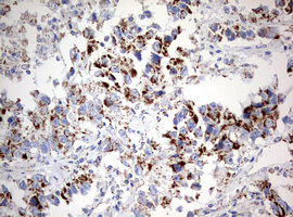 Immunohistochemical staining of paraffin-embedded Adenocarcinoma of Human ovary tissue using anti-NDUFS2 mouse monoclonal antibody