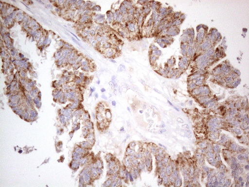 Immunohistochemical staining of paraffin-embedded Adenocarcinoma of Human ovary tissue using anti-PISD mouse monoclonal antibody