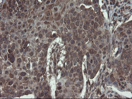 Immunohistochemical staining of paraffin-embedded Carcinoma of Human lung tissue using anti-ACBD3 mouse monoclonal antibody
