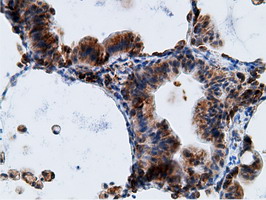 Immunohistochemical staining of paraffin-embedded Carcinoma of Human lung tissue using anti-KHK mouse monoclonal antibody
