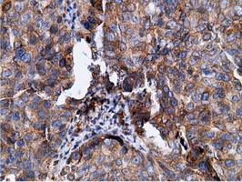 Immunohistochemical staining of paraffin-embedded Adenocarcinoma of Human ovary tissue using anti-KHK mouse monoclonal antibody