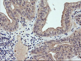 Immunohistochemical staining of paraffin-embedded Adenocarcinoma of Human ovary tissue using anti-RAB21 mouse monoclonal antibody