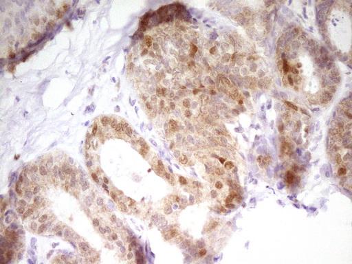 Immunohistochemical staining of paraffin-embedded Adenocarcinoma of Human breast tissue using anti-PAPSS2 mouse monoclonal antibody
