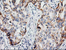 Immunohistochemical staining of paraffin-embedded Carcinoma of Human lung tissue using anti-PPM1B mouse monoclonal antibody