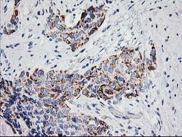 Immunohistochemical staining of paraffin-embedded Adenocarcinoma of Human breast tissue using anti-PPM1B mouse monoclonal antibody