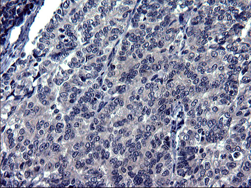 Immunohistochemical staining of paraffin-embedded Adenocarcinoma of Human endometrium tissue using anti-TXNDC5 mouse monoclonal antibody