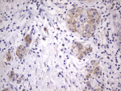 Immunohistochemical staining of paraffin-embedded Carcinoma of Human pancreas tissue using anti-ITGB1BP1 mouse monoclonal antibody
