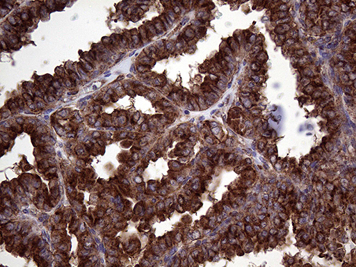 Immunohistochemical staining of paraffin-embedded Carcinoma of Human thyroid tissue using anti-CLTA mouse monoclonal antibody