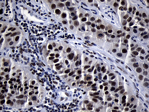 Immunohistochemical staining of paraffin-embedded Carcinoma of Human lung tissue using anti-ZHX2 mouse monoclonal antibody