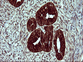 Immunohistochemical staining of paraffin-embedded Adenocarcinoma of Human ovary tissue using anti-TUBB2B mouse monoclonal antibody