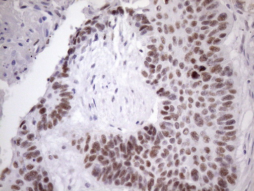 Immunohistochemical staining of paraffin-embedded Carcinoma of Human lung tissue using anti-SRSF9 mouse monoclonal antibody
