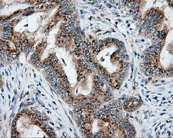 Immunohistochemical staining of paraffin-embedded Adenocarcinoma of colon tissue using anti-NIT2 mouse monoclonal antibody