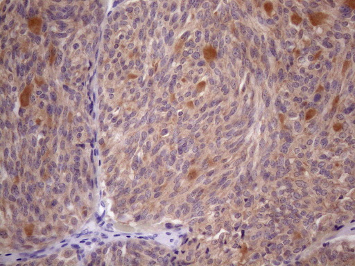 Immunohistochemical staining of paraffin-embedded Human thyroid tissue within the normal limits using anti-SSX2IP mouse monoclonal antibody