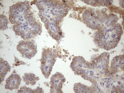 Immunohistochemical staining of paraffin-embedded Carcinoma of Human thyroid tissue using anti-SSX2IP mouse monoclonal antibody