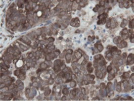 Immunohistochemical staining of paraffin-embedded Adenocarcinoma of Human ovary tissue using anti-MIPEP mouse monoclonal antibody
