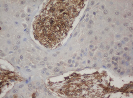 Immunohistochemical staining of paraffin-embedded Carcinoma of Human lung tissue using anti-HBS1L mouse monoclonal antibody