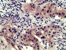 Immunohistochemical staining of paraffin-embedded Carcinoma of Human bladder tissue using anti-SH3GL1 mouse monoclonal antibody