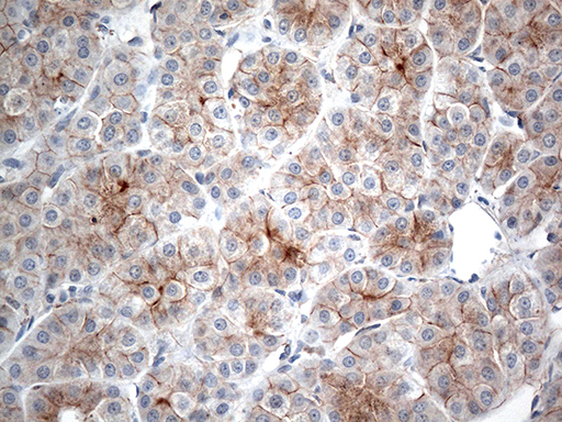 Immunohistochemical staining of paraffin-embedded Carcinoma of Human liver tissue using anti-IFNLR1 mouse monoclonal antibody
