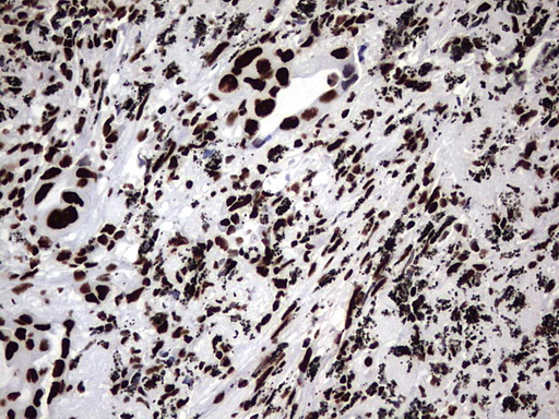 Immunohistochemical staining of paraffin-embedded Carcinoma of Human lung tissue using anti-HNRNPM mouse monoclonal antibody