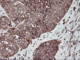 Immunohistochemical staining of paraffin-embedded Adenocarcinoma of Human ovary tissue using anti-KCNAB1 mouse monoclonal antibody