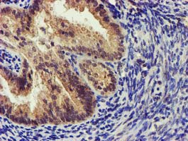 Immunohistochemical staining of paraffin-embedded Adenocarcinoma of Human endometrium tissue using anti-KCNAB1 mouse monoclonal antibody