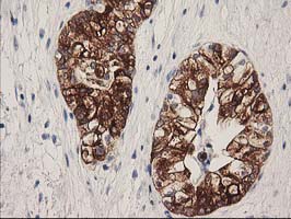 Immunohistochemical staining of paraffin-embedded Adenocarcinoma of Human ovary tissue using anti-ATP6V1B1 mouse monoclonal antibody