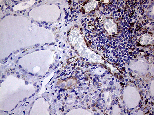 Immunohistochemical staining of paraffin-embedded Human thyroid tissue within the normal limits using anti-MLPH mouse monoclonal antibody