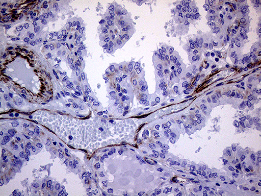 Immunohistochemical staining of paraffin-embedded Carcinoma of Human thyroid tissue using anti-MLPH mouse monoclonal antibody