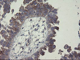 Immunohistochemical staining of paraffin-embedded Adenocarcinoma of Human ovary tissue using anti-CLEC4E mouse monoclonal antibody
