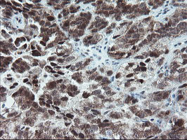 Immunohistochemical staining of paraffin-embedded Adenocarcinoma of Human ovary tissue using anti-NUB1 mouse monoclonal antibody