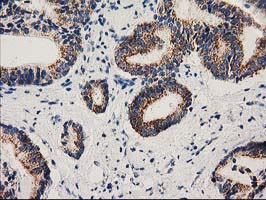 Immunohistochemical staining of paraffin-embedded Carcinoma of Human prostate tissue using anti-MMAB mouse monoclonal antibody