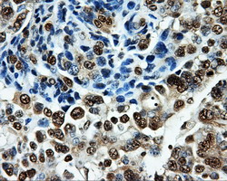 Immunohistochemical staining of paraffin-embedded Adenocarcinoma of Human ovary tissue using anti-PKMYT1 mouse monoclonal antibody