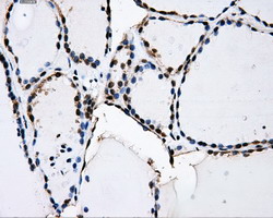 Immunohistochemical staining of paraffin-embedded Human thyroid tissue within the normal limits using anti-PKMYT1 mouse monoclonal antibody
