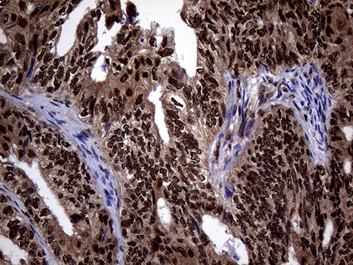 Immunohistochemical staining of paraffin-embedded Adenocarcinoma of Human ovary tissue using anti-SSU72 mouse monoclonal antibody. (Heat-induced epitope retrieval by 1mM EDTA in 10mM Tris buffer (pH8.5) at 120°C for 3min Immunohistochemical staining of paraffin-embedded Adenocarcinoma of Human ovary tissue using anti-SSU72 mouse monoclonal antibody. (Heat-induced epitope retrieval by 1mM EDTA in 10mM Tris buffer (pH8.5) at 120°C for 3min