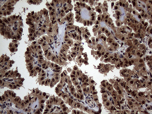 Immunohistochemical staining of paraffin-embedded Carcinoma of Human thyroid tissue using anti-SSU72 mouse monoclonal antibody. (Heat-induced epitope retrieval by 1mM EDTA in 10mM Tris buffer (pH8.5) at 120°C for 3min Immunohistochemical staining of paraffin-embedded Carcinoma of Human thyroid tissue using anti-SSU72 mouse monoclonal antibody. (Heat-induced epitope retrieval by 1mM EDTA in 10mM Tris buffer (pH8.5) at 120°C for 3min